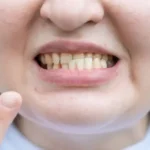 Malocclusione: Un Problema Sanitario Completamente Ignorato