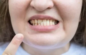 Malocclusione: Un Problema Sanitario Completamente Ignorato